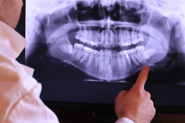 Best Emergency Root Canal Treatment in Dansville, NY